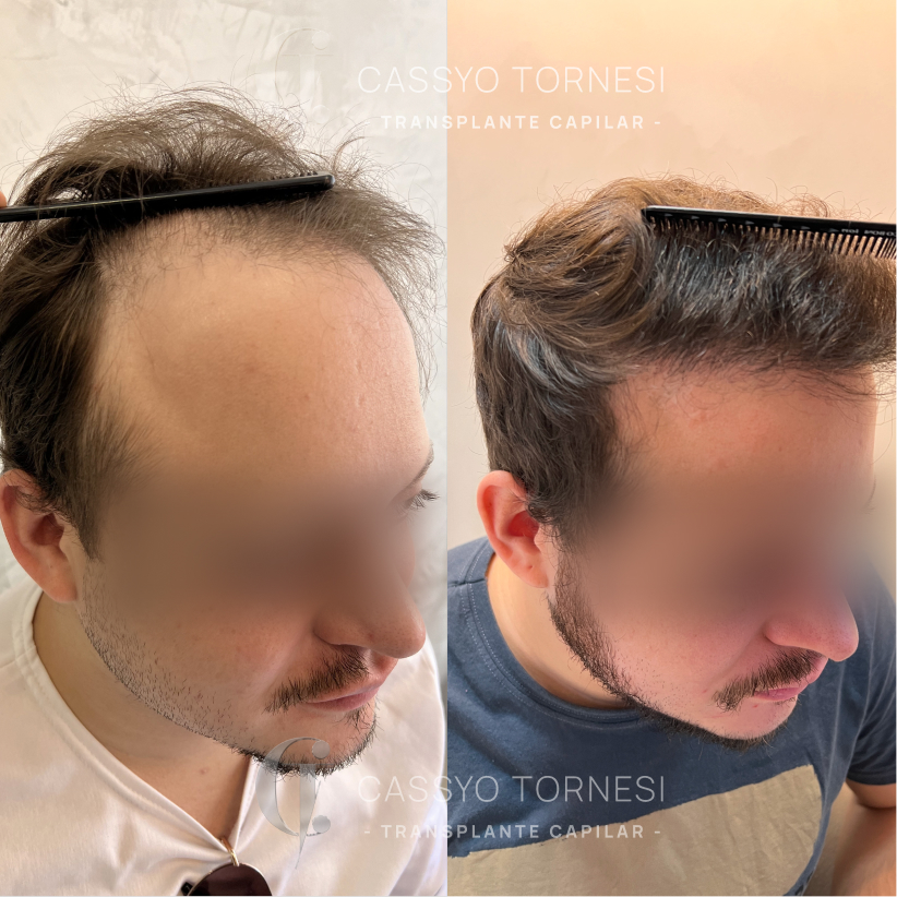 Antes e Depois do Bryan
