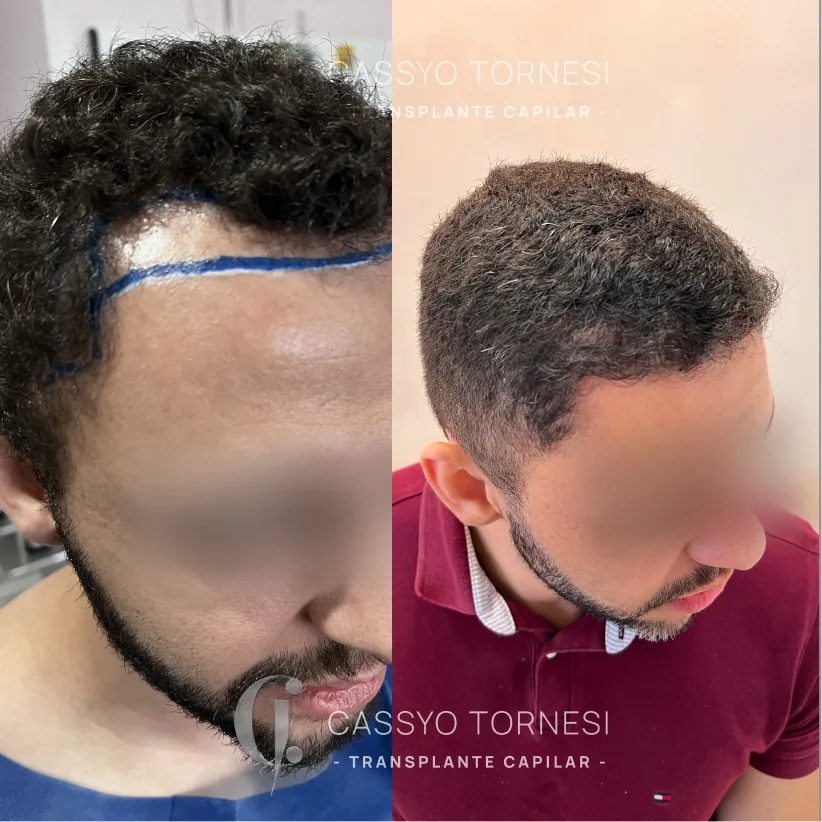 Antes e Depois do Everson