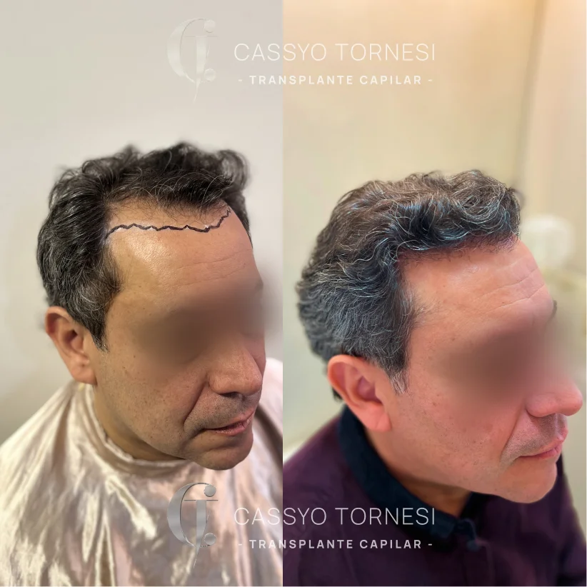 Antes e Depois do Miguel