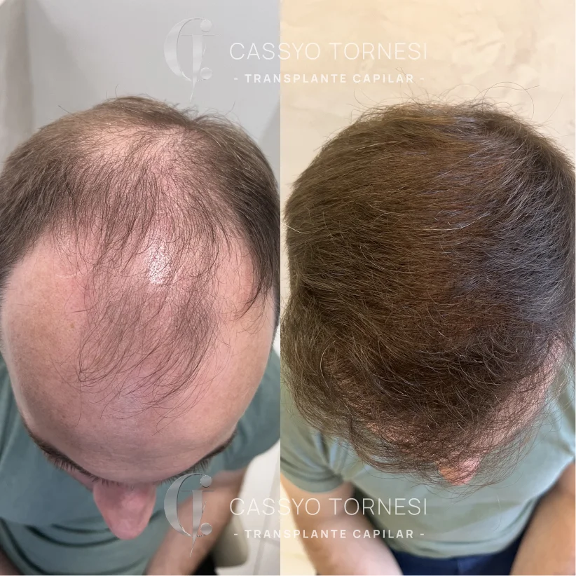 Antes e Depois do Rafael