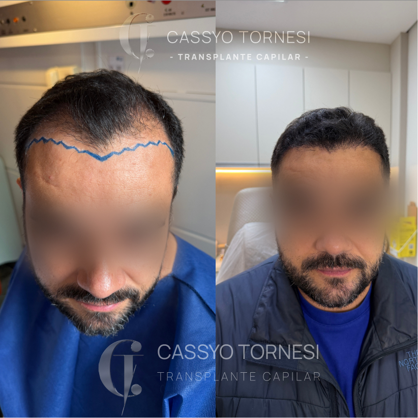 Antes e Depois do Alessandro